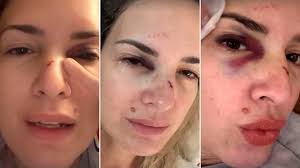 Isabel Macedo contó el diagnóstico erróneo que le dieron tras el accidente en su nariz: “La angustia que&nbsp;tengo”