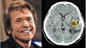 Qué es y cuáles son las secuelas del linfoma cerebral, el tipo de cáncer que le diagnosticaron a&nbsp;Raphael