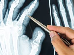 Las células madre pueden acelerar la reparación de fracturas sin cirugía, advierte un&nbsp;estudio