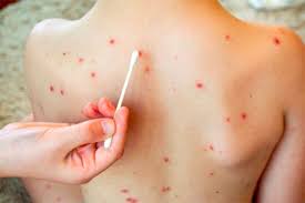 Salta refuerza la vacunación contra el sarampión en escuelas y casa por&nbsp;casa