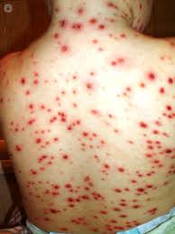 Más de 300 casos de varicela durante el primer semestre en&nbsp;Salta